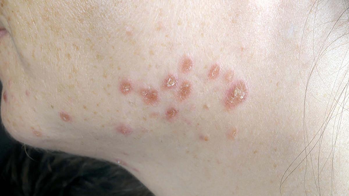 Cutaneous findings in systemic sarcoidosis.jpg