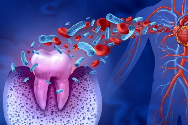 Could hidden dental bacteria help explain sudden and deadly heart attacks? Istock 1343330943.jpg